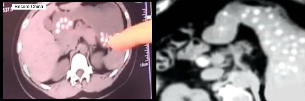 The highly sus CT scans