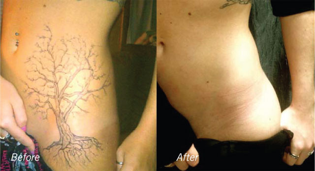 Laser Tattoo Removal | Laser Treatment for Tattoo Removal | Call Now